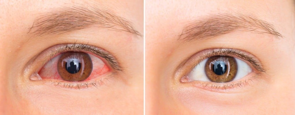 Easy Ways to Treat and Prevent Pink Eye | Kleinsorge Family Eye Care