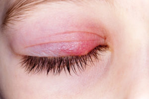 The closed eye of a child with a stye